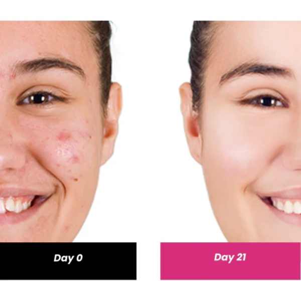 ThriveCo 2% Salicylic acid Serum, 30 ML